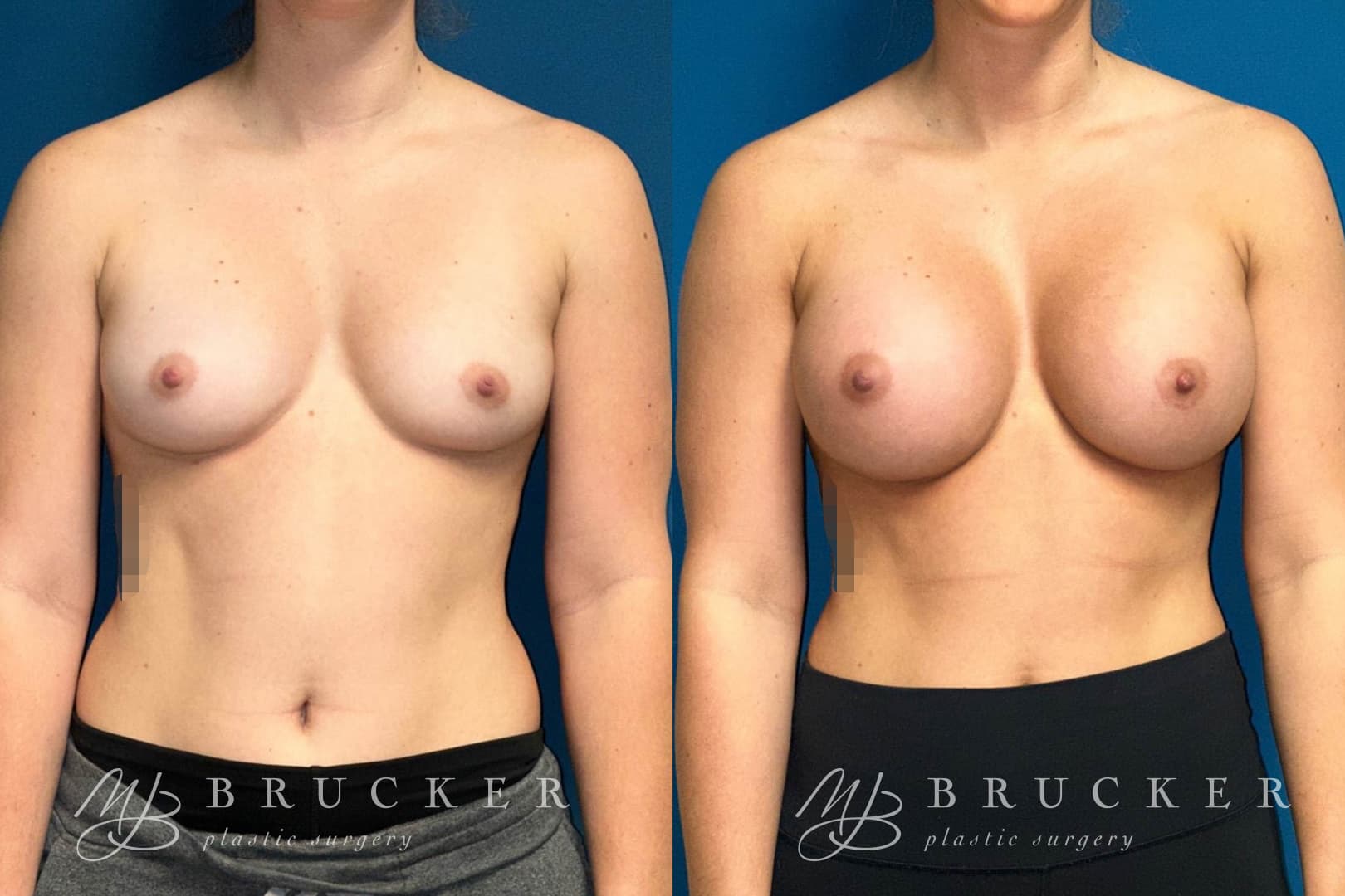 Breast Augmentation — Before and After